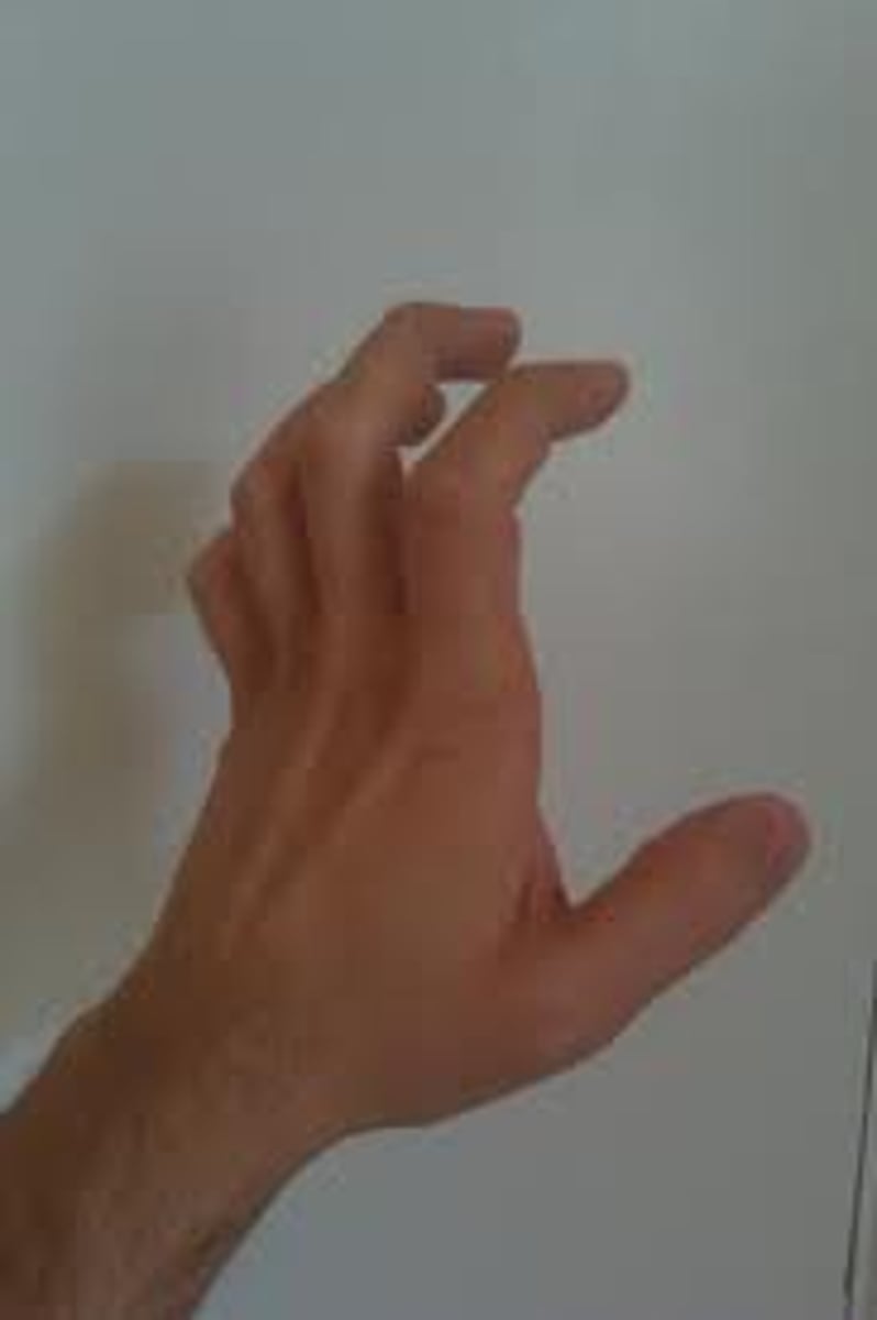 <p>Ulnar n. Injury</p><p>-CAN'T do the intrinsic plus position</p>