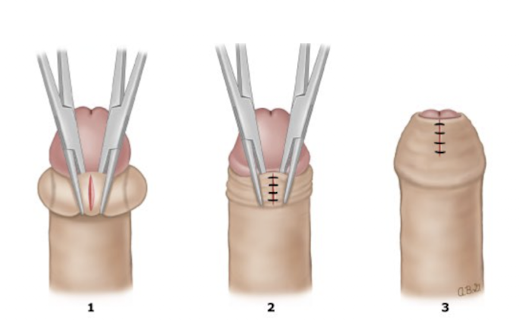 <ul><li><p>antibiotics if infection is present</p><ul><li><p>topical </p></li></ul></li><li><p>warm soaks to reduce swelling</p></li><li><p>definitive management with circumcision or dorsal slitting of the prepuce when necessary.</p></li></ul><p></p>