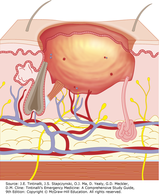 <ul><li><p>Extends into the deep dermis (reticular layer)</p><ul><li><p>Hair follicles and sweat/sebaceous glands damaged but deeper structures usually spared </p></li></ul></li><li><p>Causes: hot liquids (oil or grease), steam, flame </p></li><li><p>Skin may be blistered, exposed dermis is <strong>pale white to yellow</strong> </p><ul><li><p>Burned area <strong>does not blanch</strong> and has absent capillary refill and <strong>absent pain </strong></p></li></ul></li><li><p>Difficult to distinguish from full thickness </p></li><li><p>Heals over 3 weeks to 2 months </p><ul><li><p>Scarring common </p></li><li><p>Surgical debridement and skin grafting may be required to obtain maximum function </p></li></ul></li></ul><p></p>