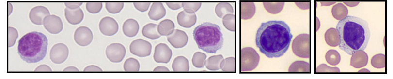 <p>- Immunologically competent cells</p><p>- Produced in bone marrow and thymus</p><p>- BM: 10-15% of BM cells; T : B ratio = 6:1</p><p>- 20 - 45% of white cells (= 1.5 - 4 x109/L)</p><p>- PB: T (70-85%) and B (5-25%) lymphocytes</p><p>- Round cells with mature chromatin</p><p>- Some are larger and have cytoplasmic granules</p>
