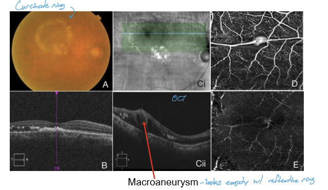 <p>They can lead to edema, lipid exudation, or multilayered retinal hemorrhages (subretinal, intraretinal, or preretinal). Vision loss results from macular involvement or rupture.</p>