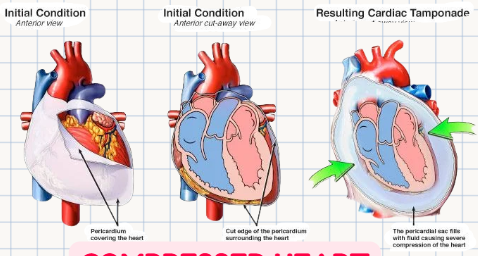 <p><strong>Mechanical compression</strong> of the heart by a large amount of fluid or blood within the pericardial space that <strong>limits the normal range of motion and function</strong> of the heart.</p>
