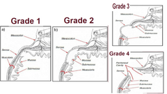 <p>Rectal tear grade with Mucosa & submucosa intact, only the muscular layer disrupted</p><p>-Rare grade; No blood on sleeve & no treatment without creating a stricture</p>