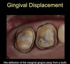 <p>also known as gingival retraction</p><p>the deflection of the marginal gingiva away from a tooth</p><p>process of exposing the preparation finish to line by pushing the gingiva away from the prep</p>