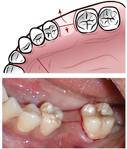 <p><span>Advantages are:<br>convenient retraction, better access and visualization; additional procedures such as bone grafting can be done</span></p><p><span>• Example: </span><span style="color: rgb(255, 0, 0);">midcrestal incision </span><span>(mesial-distal surfaces of the teeth adj to the edentulous space)</span></p>