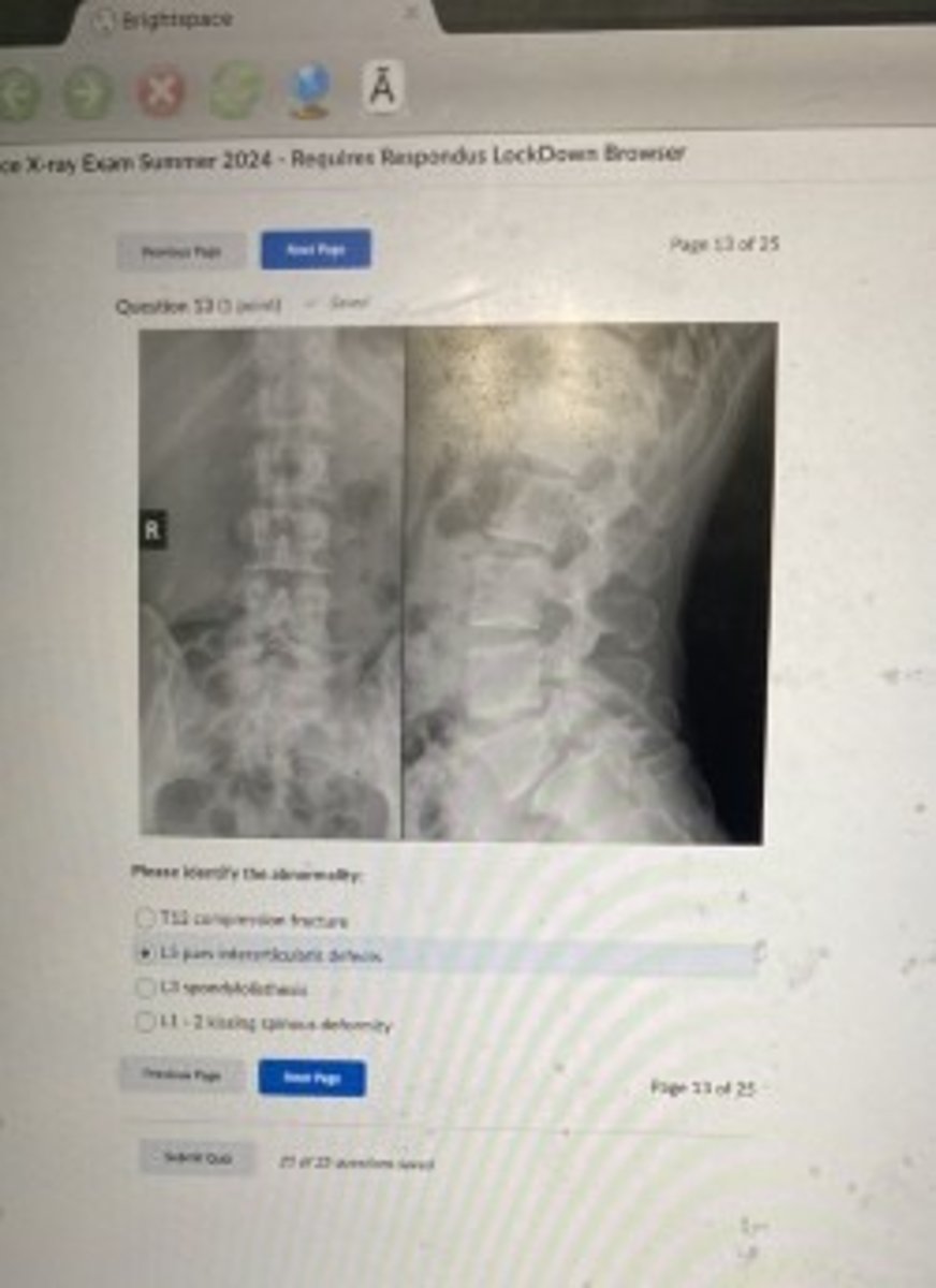 <p>L5 interarticularis defect</p>