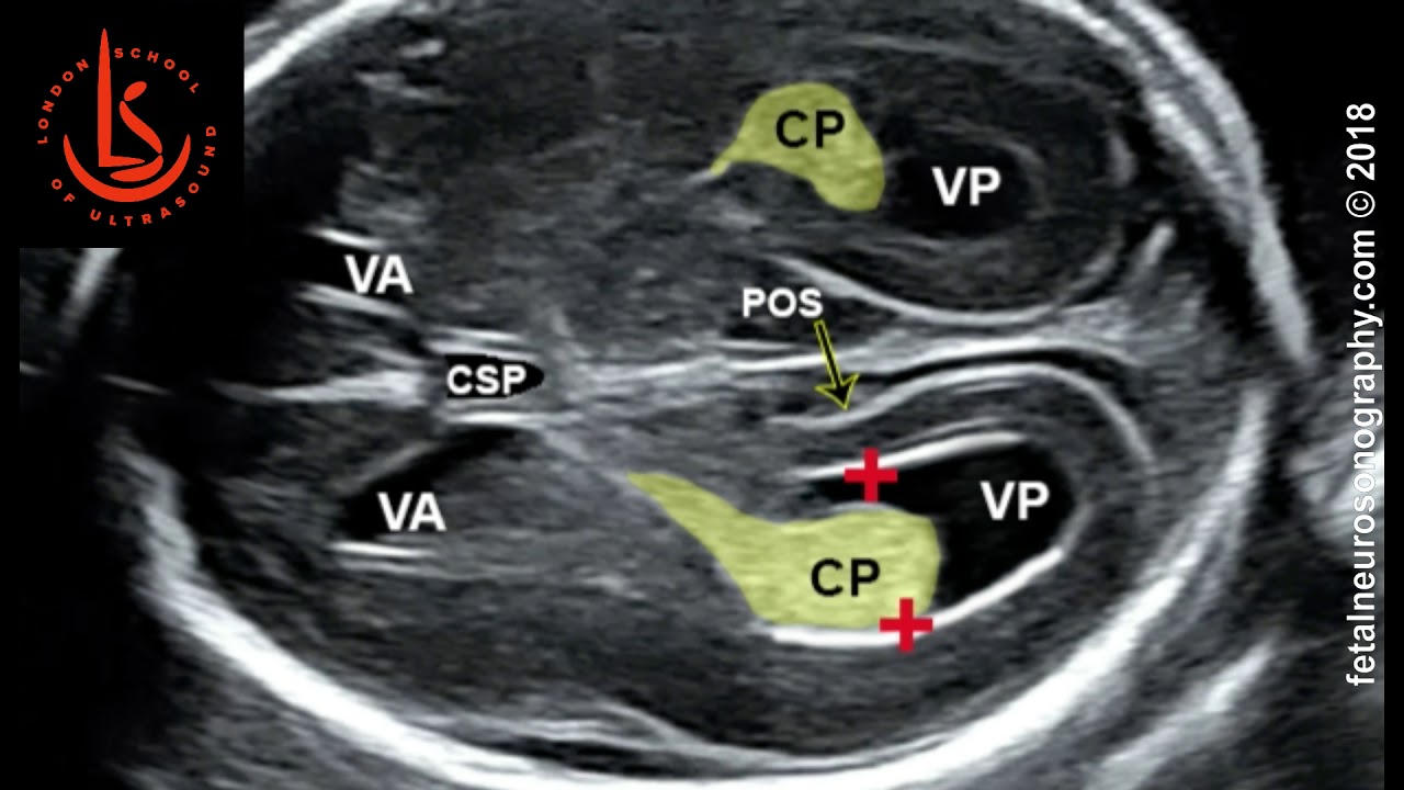 <p>Measured in axial plane at level of atrium. Should not measure more than 10mm (ventriculomegaly)</p>