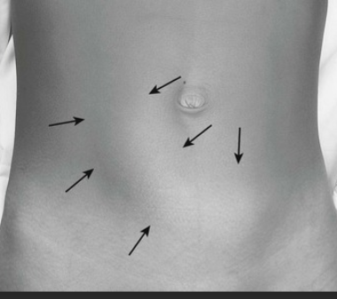 <p></p><ol><li><p><span style="color: rgb(58, 162, 165);"><strong>knees drawn to chest</strong></span></p></li><li><p><span style="color: rgb(155, 133, 39);"><strong>sausage shaped</strong> </span><span style="color: rgb(28, 26, 18);">abdominal mass</span><span style="color: rgb(155, 133, 39);"> in <strong>RUQ</strong></span></p></li><li><p><span style="color: rgb(192, 54, 54);"><strong>“Dance sign”: </strong></span><span style="color: rgb(192, 54, 54);"><strong>bowel shifts out of the RLQ, </strong></span><span style="color: rgb(21, 18, 18);">leaving that area empty due to telescope</span></p></li><li><p><span style="color: rgb(202, 40, 153);"><strong>stools mixed w blood, mucus </strong>“jelly stool”</span></p></li></ol><p></p>