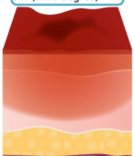 <p>Full thickness / Third degree burn?</p>