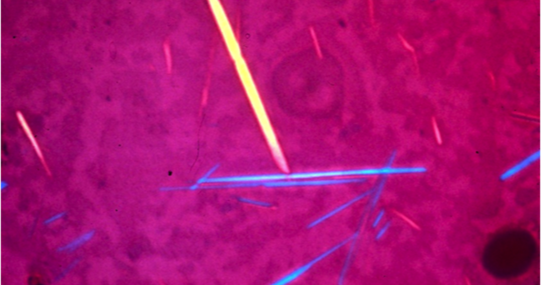 <p>monosodium urate</p><p><strong>needle-shaped</strong> crystals </p>