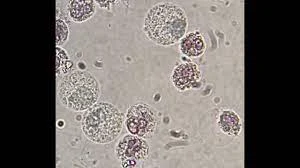 <p>A neutrophil that has swollen in hypotonic urine whose cytoplasmic granules exhibit Brownian motion, creating a sparkling or glittering appearance under the microscope.</p>