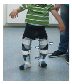 <p>Single upright KAFO (can do double uprights in heavier kids)</p><p>Adjustable uprights for growth with valgus pressure at knee center with pressure medially </p><p>Trimlines below perineum and proximal to the ankle  </p><p>Knee locked in extension </p><p>Strap/band to pull tibia medially </p>