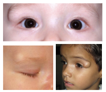 <p>What is the most likely diagnosis ?</p>