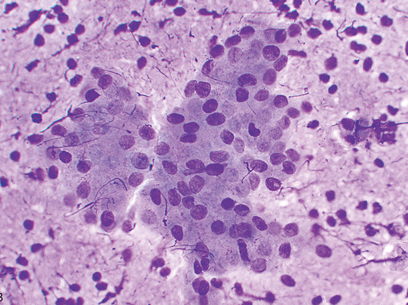<p>Cytologie parotide </p><p>1) Catégorie selon Milan</p><p>2) Diagnostic</p><p></p>