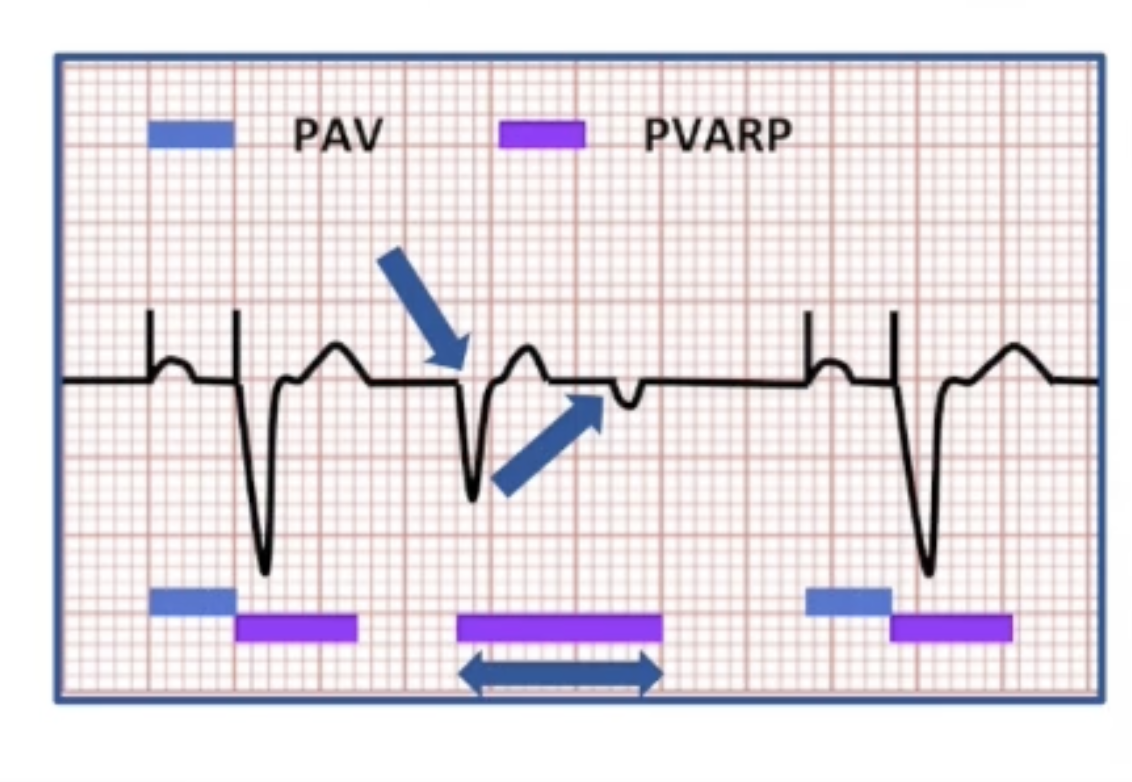 <ul><li><p>Run VA conduction test, set PVARP 50 ms longer than RVAC</p><ul><li><p>Not possible in all patients</p></li><li><p>RVAC varies over time</p></li></ul></li><li><p>PVC response: extend PVARP or atrial pace in response to PVC</p></li><li><p>Correct underlying cause</p></li></ul><p></p>