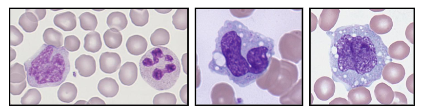<p>- 2 - 8% of white cells (= 0.2 - 0.8 x10^9/L)</p><p>- Maturation from stem cell - monoblast - monocyte</p><p>- 20 - 40 hrs in blood</p><p>- Mature to macrophage in tissue (months - years)</p><p>- Grey cytoplasm; horseshoe-shaped nucleus</p><p>- Role in phagocytosis of foreign material &amp; killing</p><p>- May have fine granules: produce &amp; release cytokines</p><p>.</p><p>- the nucleus is not segmented, its just bent</p><p>- mature from haemopoietic stem cell</p><p>- they mature to marcophage in the tissue (macro = big, phage = eating cell)</p><p>- they respond to cytokines (monocyte or macrophage colony stimulating factor) but also release cytokines (which are toxic to what has invaded)</p><p>- they are deadly to invaders but they can also be damaging to our own cells if acting in a hyperactive manner</p>