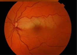 <p>Name the condition</p>