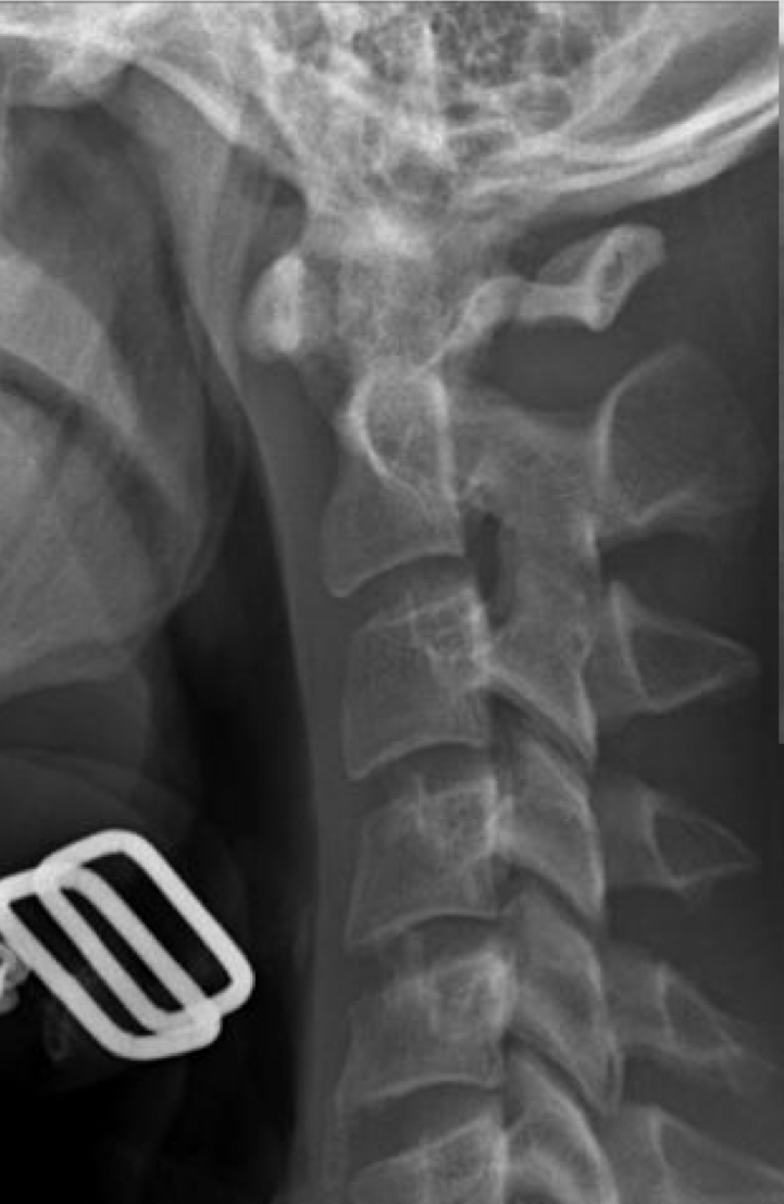 <p>What is the finding and the dx of this image</p>
