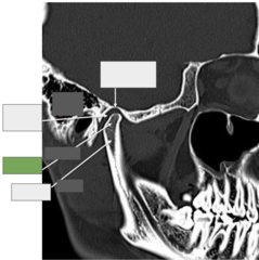 <p>TMJ: This is the</p>
