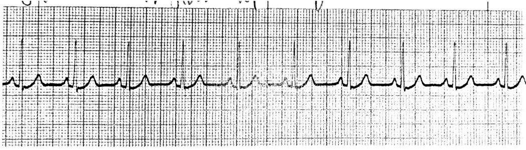 <p>how did you know this was a regular sinus rhythm </p>