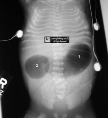 <p>Overfilled stomach and duodenum caused by duodenal atresia, most often related to trisomy 21</p>