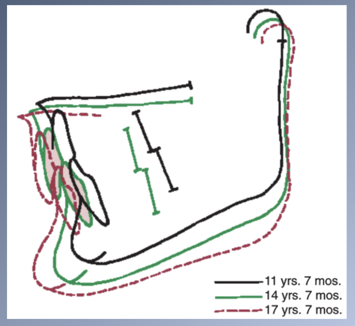 <p><span>ERUPTION PATH OF MANDIBULAR TEETH</span><br><span>- Molars tend to migrate mesially > incisors </span>→ decrease <span>arch length.</span><br><span>- Forward internal rotation >maxilla → decrease arch length Mn > Mx</span><br><span>- Changes in the A-P position of the incisors are a major influence on arch length changes!!!</span></p>