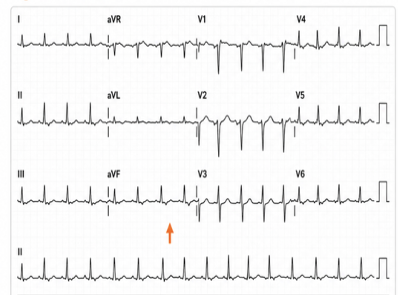 <p>casus:</p><ul><li><p>70 jaar </p></li><li><p>alarm symp → benauwd, orthopnoe, nycturie en verminderde inspanningsmogelijkheid </p></li><li><p>LO → pols van 80/min, bp 170/70 </p></li><li><p>luisteren → normale harttonen, holosystolische (tijdens gehele systole horen) souffle aan apex en mild bibasaal crepiteren </p></li></ul><p></p>