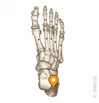 <p>Calcaneal</p>