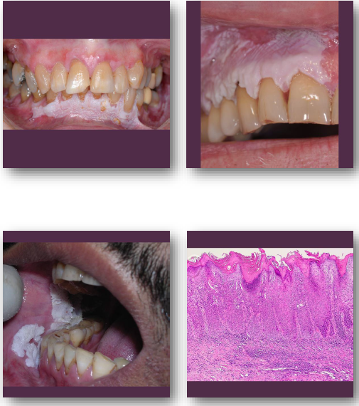 <p><strong>• Multifocal white plaques with verrucous surface</strong></p><p><strong>•Slowly enlarging and spreading over time</strong></p><p>•Often involves <strong>gingiva and alveolar mucosa</strong></p><p>•May develop<strong> red areas or ulceration</strong></p><p>•Persistent despite multiple treatments</p>