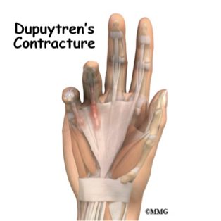 <ul><li><p>Palmar fascia</p><ul><li><p>Protective barrier between the skin and tendons: helps bend fingers</p></li><li><p>Thickens and drawn inward: causes finger to become bent by the force of the contracture</p></li><li><p>Most common affects 4th and 5th digits</p></li></ul></li><li><p>Can be linked to alcoholism/overuse</p></li><li><p>Presentation</p><ul><li><p>Scar like band at base of fingers</p></li><li><p>Inability to lay hand flat on table</p></li><li><p><strong>Unable</strong> <strong>to straighten finger mechanically: fascia has contracted and cannot push past it</strong></p></li></ul></li><li><p>Treatment</p><ul><li><p>PT/OT</p></li><li><p>Steroid injections</p></li><li><p>Radiation therapy</p></li><li><p>Enzyme therapy</p></li><li><p>Needling</p></li><li><p>Surgery → skin grafting</p></li></ul></li></ul><p></p><p></p>