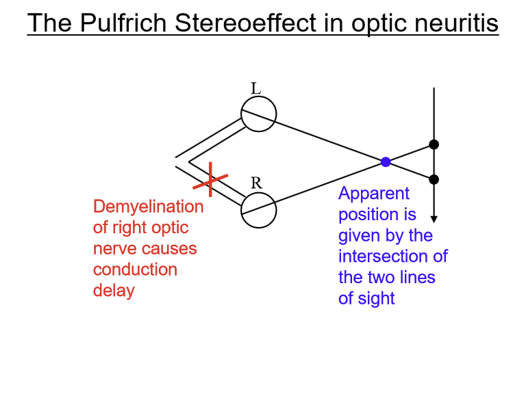 <p>A delay in visual processing between the two eyes leading to a neural timing difference that creates an illusion of depth for moving objects.</p>