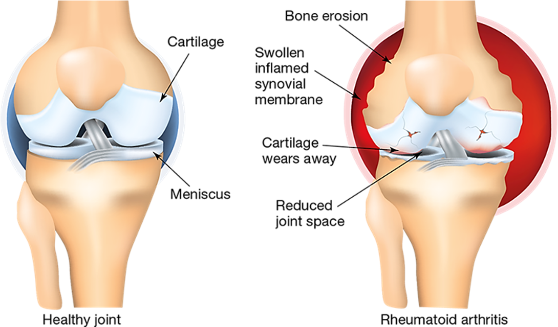<p><strong>Autoimmune diseases </strong>Rheumatoid arthritis is an autoimmune disease where excess cell growth in joint tissue causes damage</p><p><strong>Cancers </strong>Uncontrolled process of cellular division that forms tumors.</p><ol><li><p>Tumours are masses of cells growing out of control</p></li><li><p>Normally, damaged cells should undergo apoptosis (self-destruct)</p></li><li><p>Cancer cells ignore these apoptosis signals</p></li><li><p>Mutations allow cancer cells to grow uncontrollably and crowd out healthy cells</p></li></ol><p></p>
