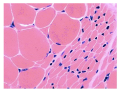 <p>What are examples of Atrophy? (2)</p>