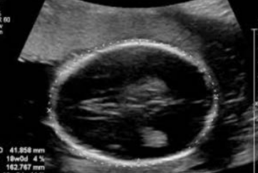 <p>What is being depicted in this image?</p><p>a. Dandy-Walker malformation</p><p>b. Hydranencephaly</p><p>c. Normal fetal brain</p><p>d. Absence of the corpus callosum</p>