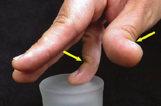 <ul><li><p>Flexible or loose joints</p></li><li><p>Also known as double jointed </p></li><li><p>4—13% of children have hypermobile joints (move beyond normal range) </p></li></ul><p></p>