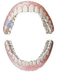 <p>maxillary right first molar</p>