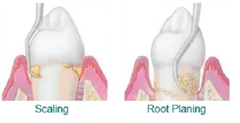 <p>Root planing</p>