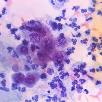 <p><em>Centers for Disease Control and Prevention. (n.d.). Papanicolaou test showing cervical adenocarcinoma [Photomicrograph]. Public Health Image Library, Image ID 19471.</em></p>