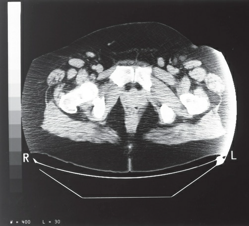 <p>The image in the figure was produced using the following</p><p>parameters: large (full) scan field of view (SFOV); maximum</p><p>display field of view (DFOV) (48 cm); 200 mA, 120 kVp; soft</p><p>tissue algorithm. Which of the following technical adjustments</p><p>would serve to reduce the artifact present?</p><p>a. switching to a detail or bone algorithm</p><p>b. using a smaller SFOV</p><p>c. increasing the mA to 240 and the kVp to 140</p><p>d. centering the patient within the SFOV</p>