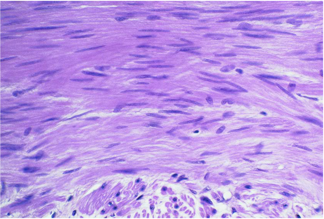 <p>No stripes, Spindle-shaped cells wide in the middle and tapered at both ends. One central nucleus in each cell, usually elongated or cigar-shaped. No visible striations — this is the biggest clue. Cells are arranged in sheets or layers, often running in the same general direction.</p>