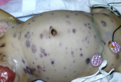<p>Toxoplasmosis</p><p>Other (syphilis, varicella-zoster, parvovirus B19)</p><p>Rubella</p><p>Cytomegalovirus (CMV)</p><p>Herpes infections</p><p>All can cause congenital infections and produce thromobocytopenia, thrombotic thrombocytopenia purpura (TTP) or blueberry muffin rash</p>