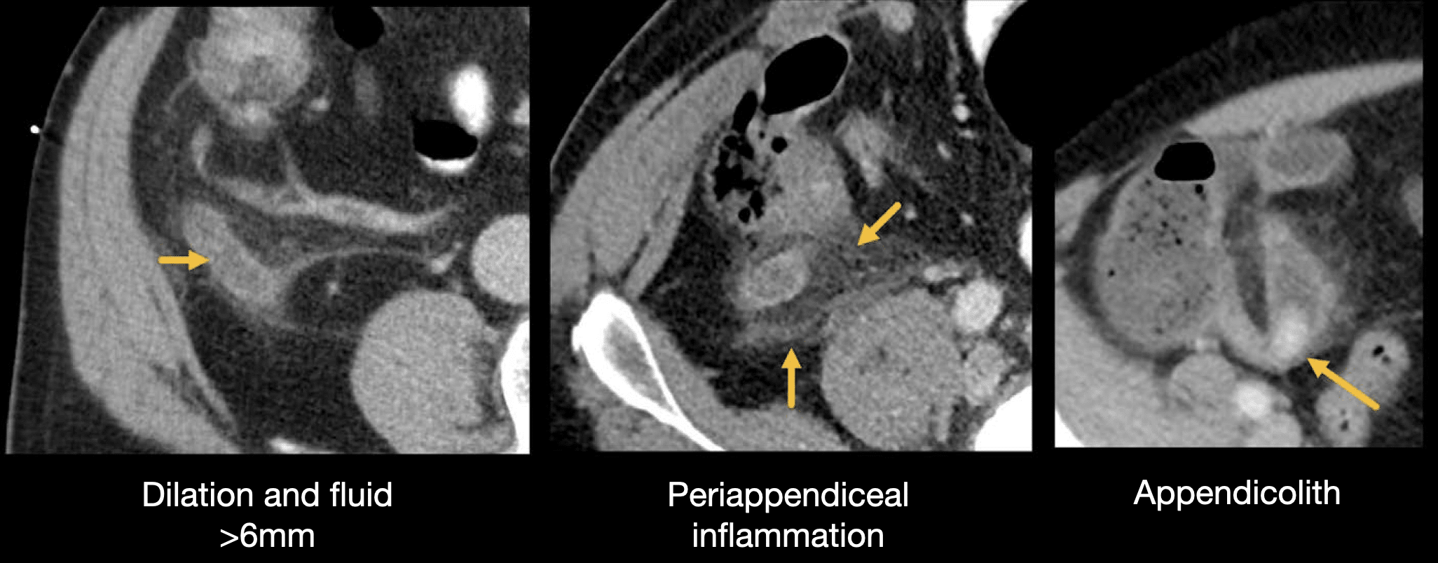 <p><strong>Enlarged appendix (>6 mm)</strong></p><p><strong>Wall thickening</strong></p><p><strong>Periappendiceal fat stranding</strong></p>