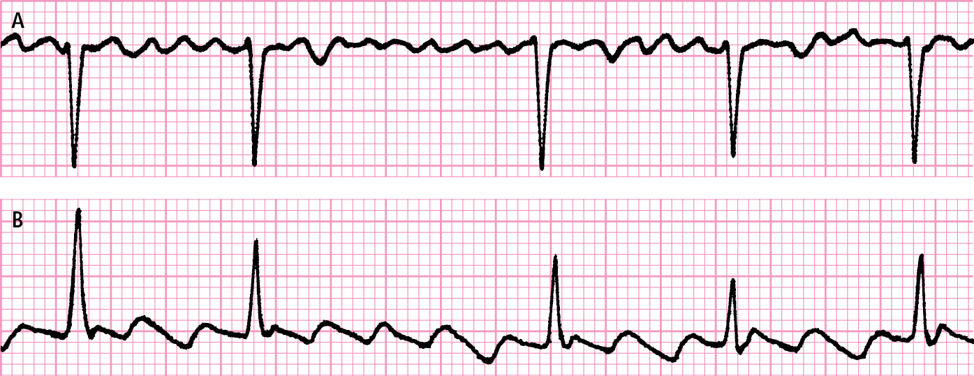 <p>najczęstsza tachyarytmią nadkomorową, którą cechuje szybka, nieskoordynowana aktywacja przedsionków, prowadząca do utraty efektywności hemodynamicznej ich skurczu, czemu towarzyszy niemiarowy rytm komór</p><p></p><p>niemiarowość zupełna, brak p - fala małe f, </p><p></p><p>A - migotanie      B - trzepotanie</p>