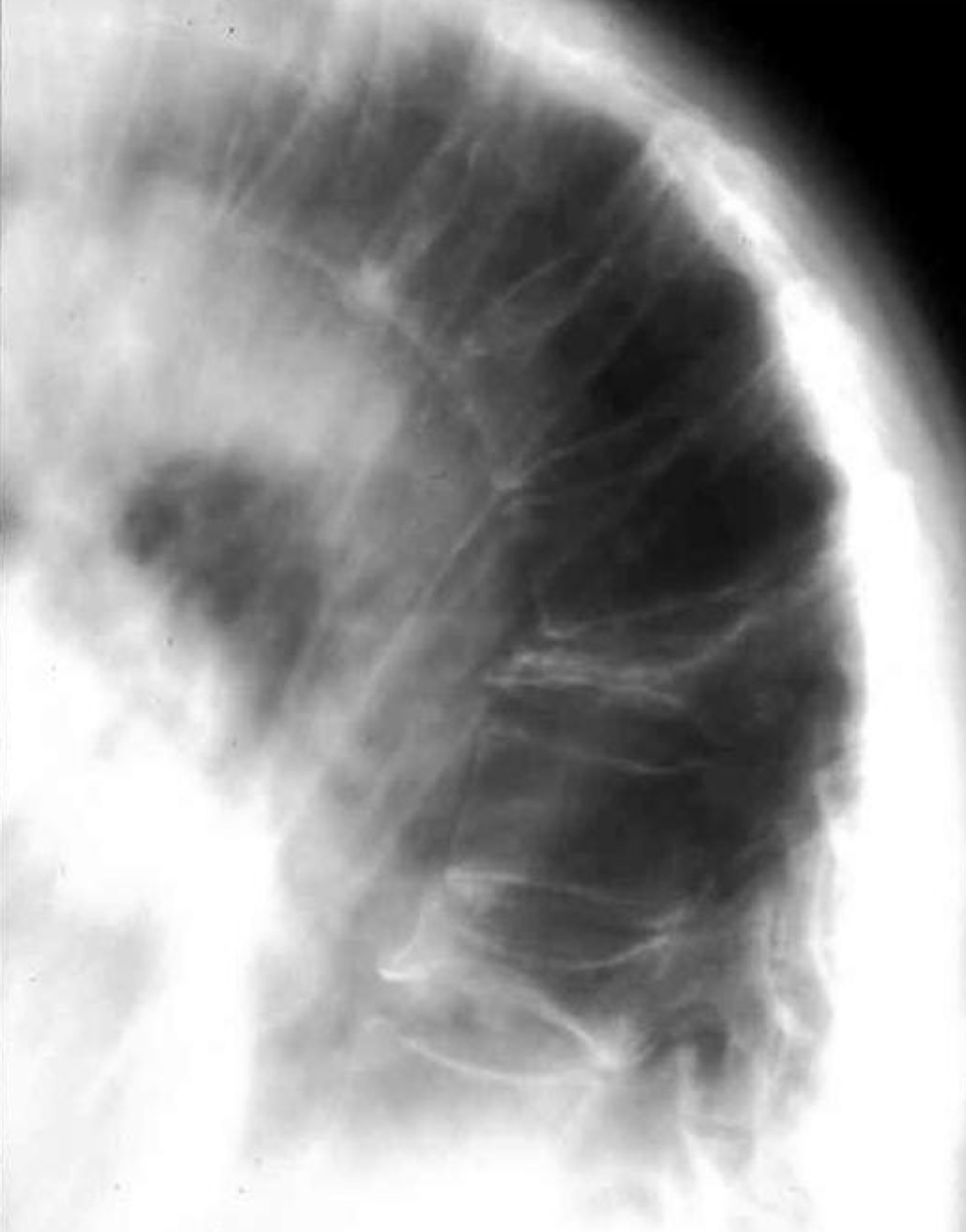 <p>What is the most likely etiology of this compression fracture</p>