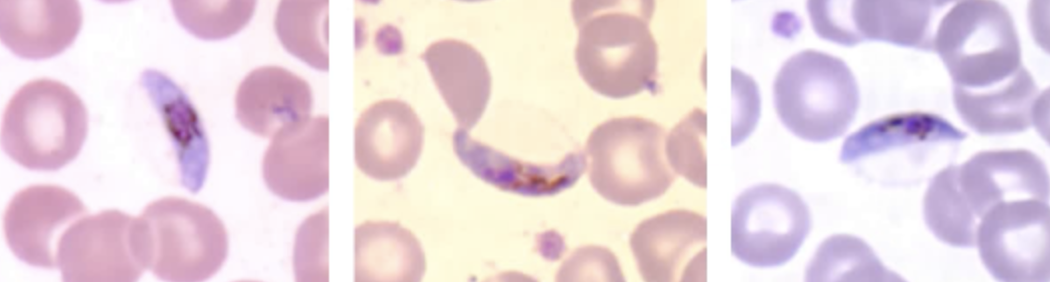 <ul><li><p><span style="background-color: transparent;">The gametocyte of Plasmodium falciparum is typically sausage- or crescent-shaped. </span></p></li><li><p><span style="background-color: transparent;">The chromatin is usually compact, and black pigment surrounds the chromatin, which may be visible.</span></p></li><li><p><span style="background-color: transparent;"><strong><u>This form is diagnostic</u></strong> for Plasmodium falciparum, meaning that is not seen with other Plasmodium species.</span></p></li></ul><p></p>