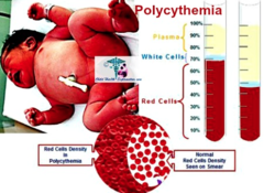<p>Red blood cell count too high, due to bone marrow response to chronically low oxygen or malignancy.</p>