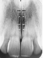 <p>Median Palatal Suture</p>