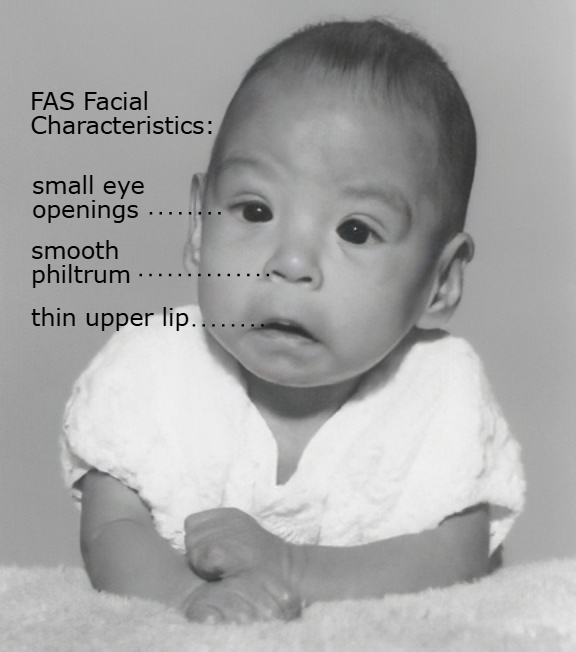 <p>Condition affecting children of mothers who consumed alcohol during pregnancy </p><p>-Presentation: Must have all three </p><ul><li><p>Characteristic facial features → smooth philtrum, thin vermilion border of the upper lip, short palpebral fissures </p></li><li><p>Pre- and/or postnatal growth restriction</p></li><li><p>Central nervous system abnormalities → microcephaly, intellectual disability, learning disabilities, hyperactive and impulsive behaviors, executive dysfunction </p></li></ul><p>-Can also have congenital heart defects like VSD and ASD </p><p>-Dx: clinical diagnosis </p><p>-Tx: prevention is the only cure </p>