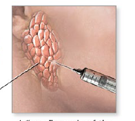 <ul><li><p>using a small diameter needle </p></li></ul><p></p>