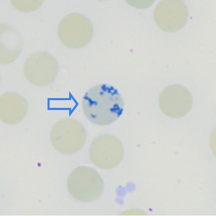 <p>large clumps of RNA which indicates active regeneration</p>